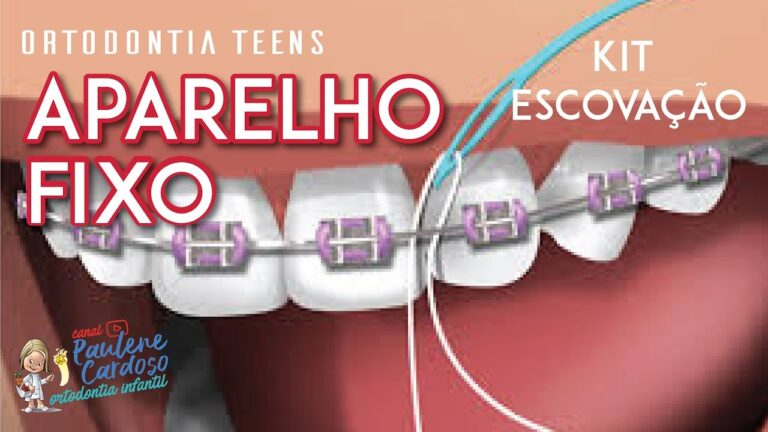 Como Limpar Aparelho Dent&aacute;rio Usando Fio Dental