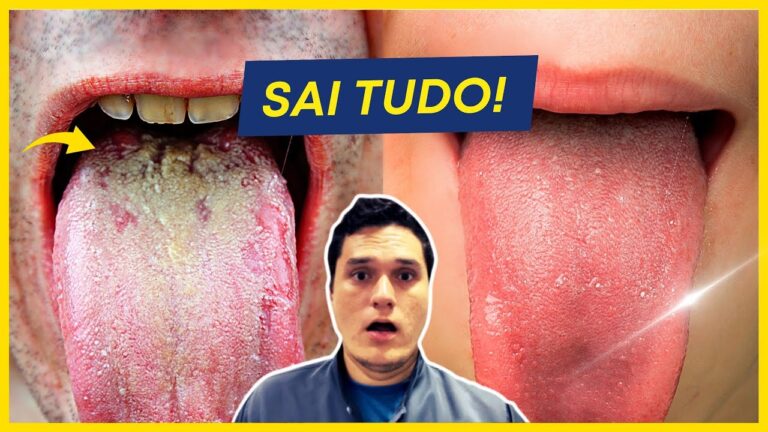 Como Eliminar a Língua Amarela de Forma Eficaz