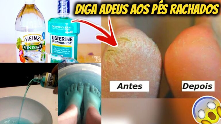 Limpeza Eficiente dos P&eacute;s com Listerine e Vinagre