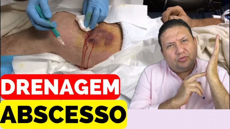 Como Limpar um Abscesso com Pus de Forma Eficiente