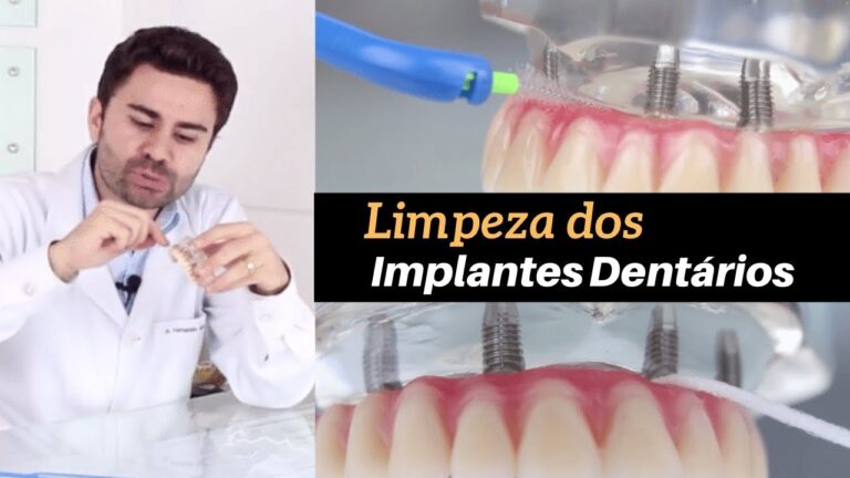 Guia Pr&aacute;tico: Como Limpar Implantes Dent&aacute;rios Eficazmente