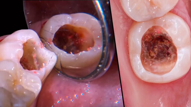 Como Limpar Cáries em Placas Dentárias