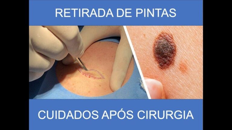 Guia Pr&aacute;tico: Como Limpar um Sinal no Corpo