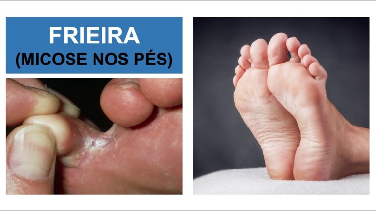 Eficácia do Betadine na Limpeza de Fungos