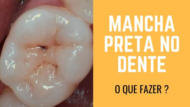 Como Remover Dente Preto de Forma Eficiente