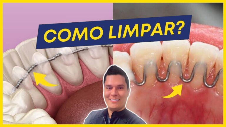 Como Limpar Aparelho de Contenção Fixo