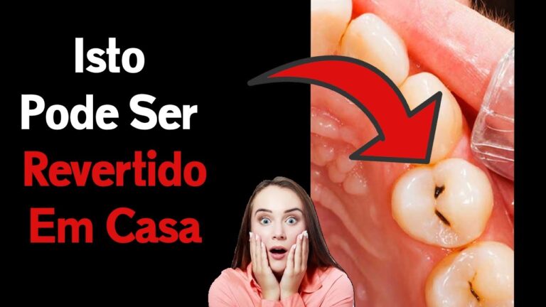Como Remover Cáries dos Dentes de Forma Eficaz
