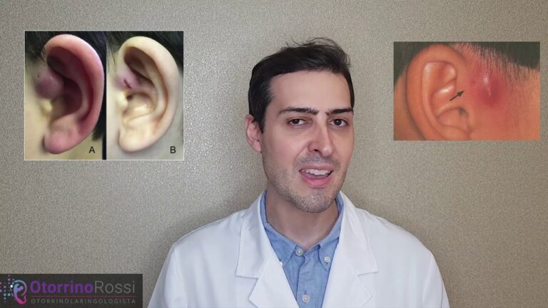 Como Limpar o Sinus Pré-Auricular de Forma Eficiente